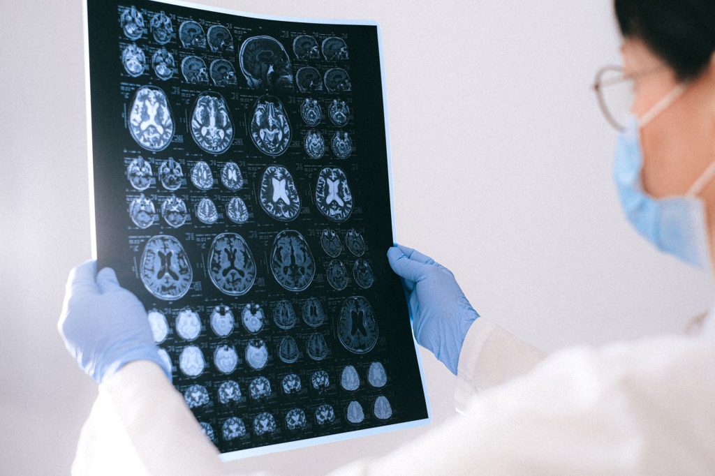 Alzheimer’s Disease Treatment: Proven New Hope for Patients