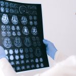 Alzheimer’s Disease Treatment: Proven New Hope for Patients