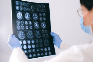 Alzheimer’s Disease Treatment: Proven New Hope for Patients